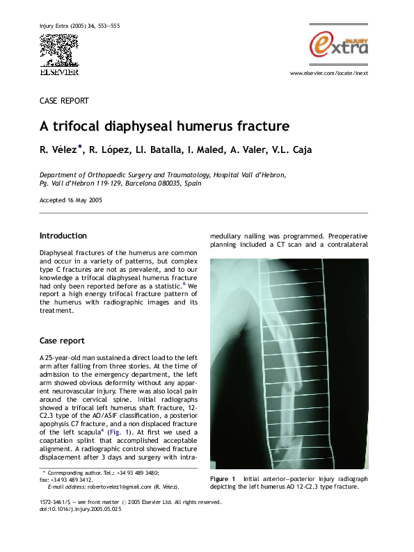 (PDF) A trifocal diaphyseal humerus fracture