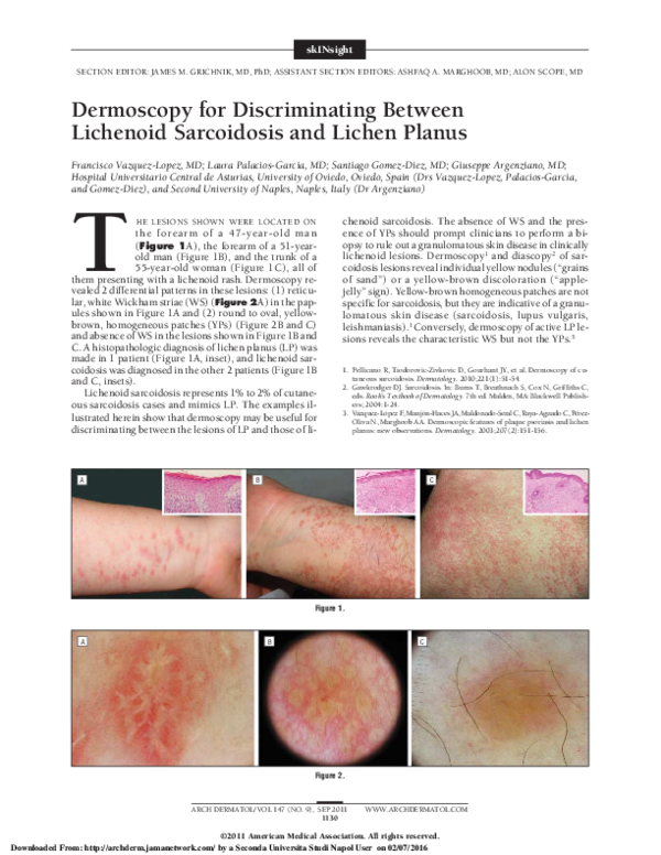 (PDF) Dermoscopy for Discriminating Between Lichenoid Sarcoidosis and ...