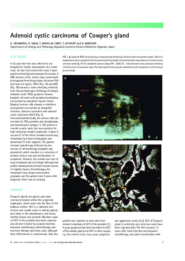 (PDF) Adenoid cystic carcinoma of Cowper's gland Takeshi Igawa Academia.edu