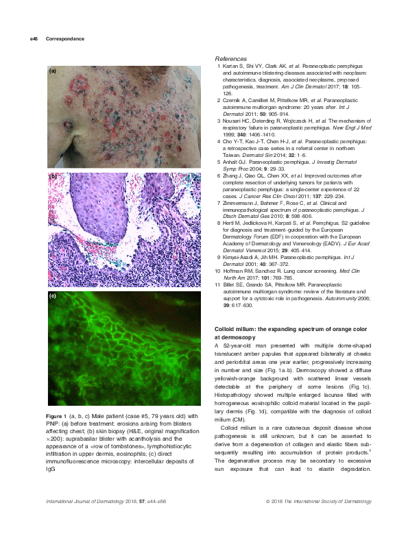 (PDF) Colloid milium the expanding spectrum of orange colorat
