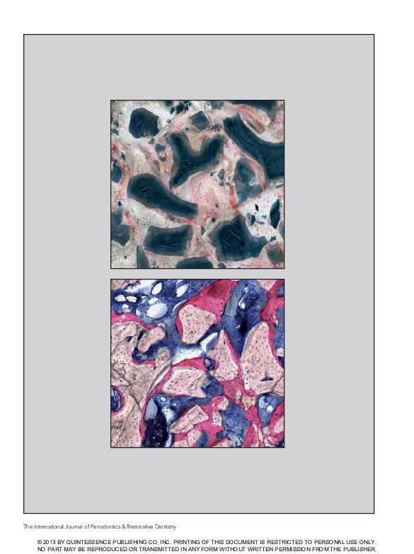 (PDF) FROUM 2013 A histomorphometric comparison of Bio Oss alone versus ...