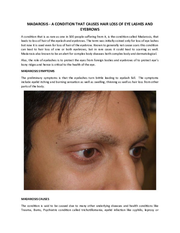 (PDF) MADAROSIS A CONDITION THAT CAUSES HAIR LOSS OF EYE LASHES AND