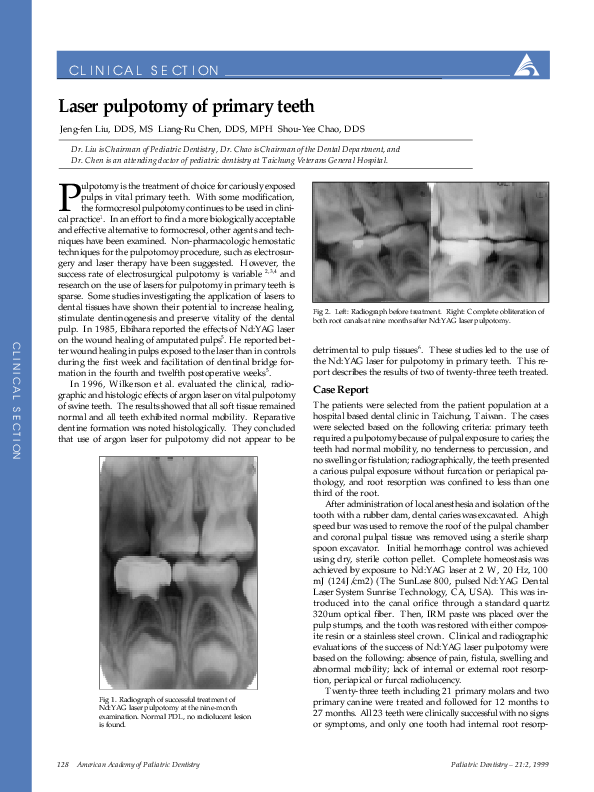 (PDF) Laser pulpotomy of primary teeth Surabhi Bhardwaj Academia.edu