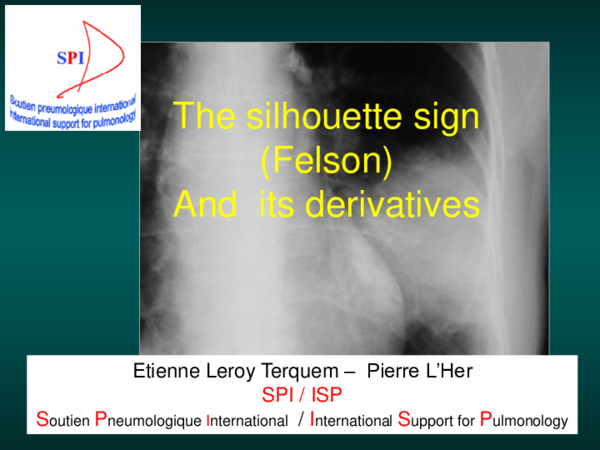 (PDF) The silhouette sign (Felson) And its derivatives Etienne Leroy ...