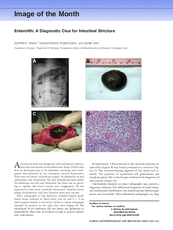 (PDF) Enterolith: A Diagnostic Clue for Intestinal Stricture