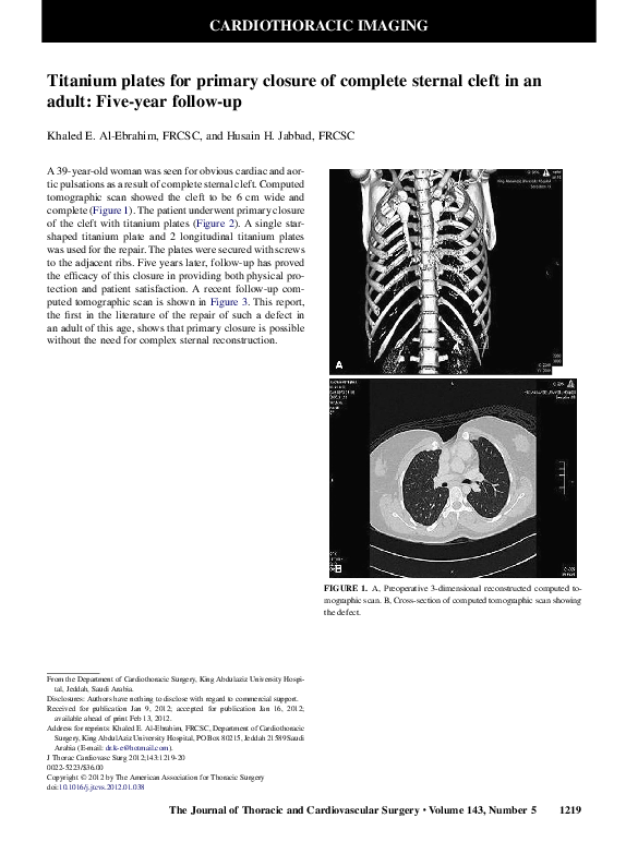 (PDF) Titanium plates for primary closure of complete sternal cleft in an adult Fiveyear