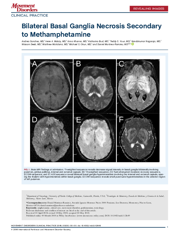 (PDF) Bilateral Basal Ganglia Necrosis Secondary to Methamphetamine CLINICAL PRACTICE Daniel