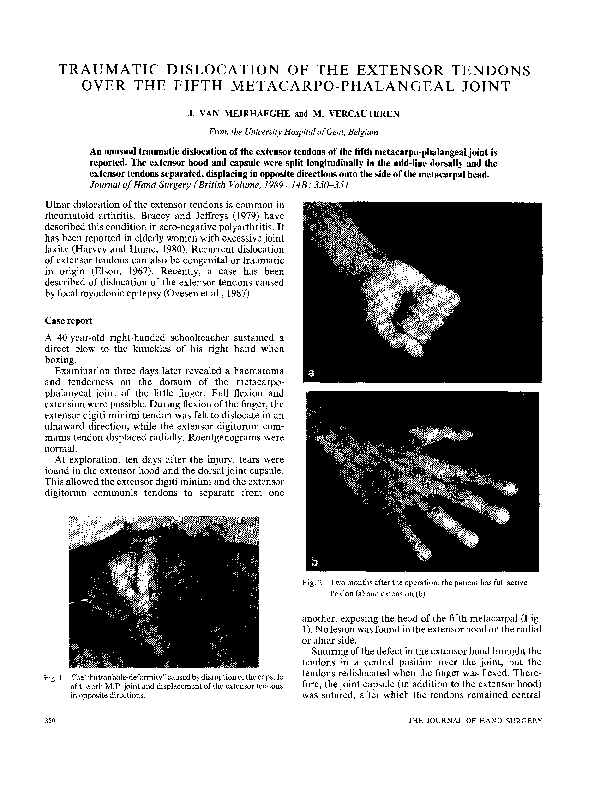 (PDF) Traumatic dislocation of the extensor tendons over the fifth ...