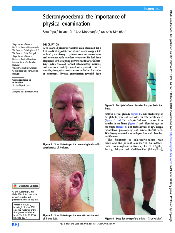 pdf-scleromyxoedema-the-importance-of-physical-examination-juliana