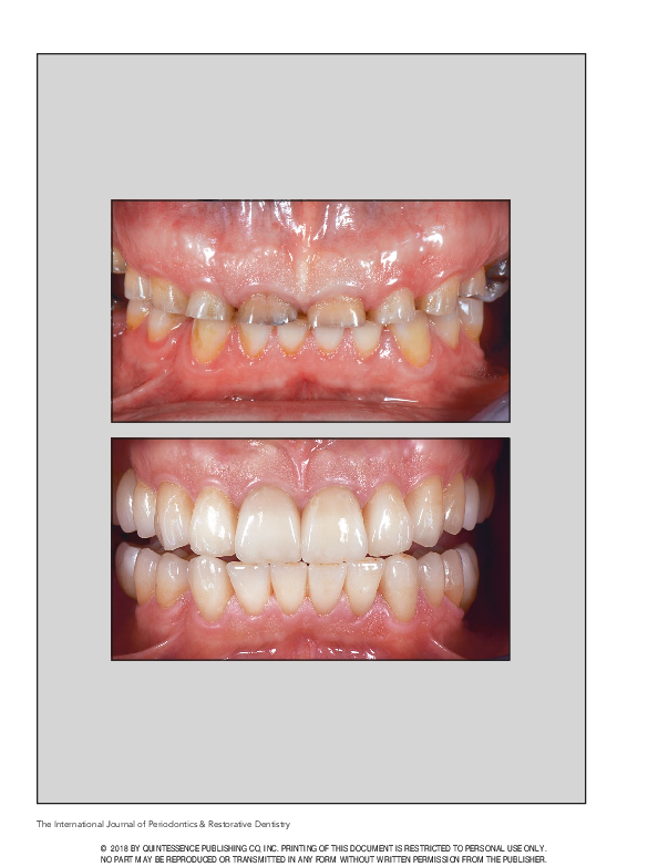 PDF) Increasing the Vertical Dimension of Occlusion: A Multicenter