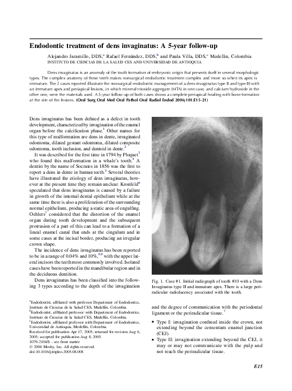(PDF) Endodontic treatment of dens invaginatus: A 5-year follow-up