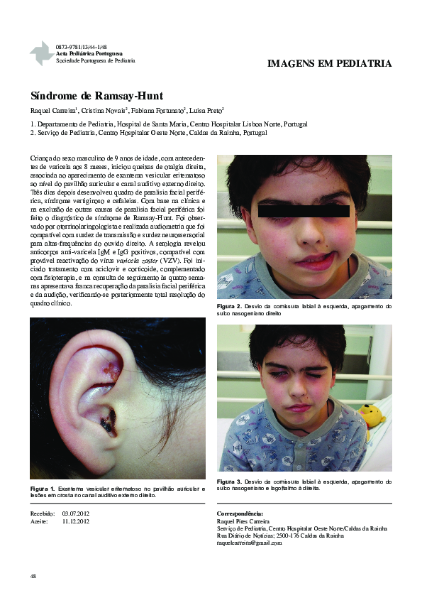 (PDF) Síndrome de Ramsay-Hunt