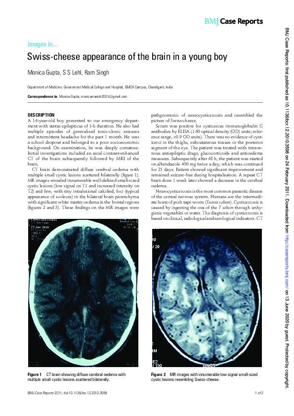 (PDF) Swisscheese appearance of the brain in a young boy Sarabmeet