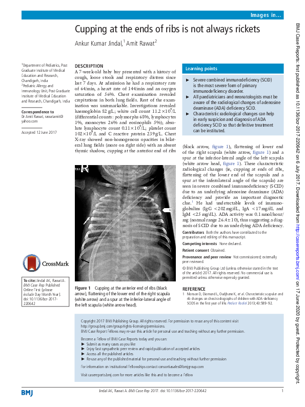 (PDF) Cupping at the ends of ribs is not always rickets