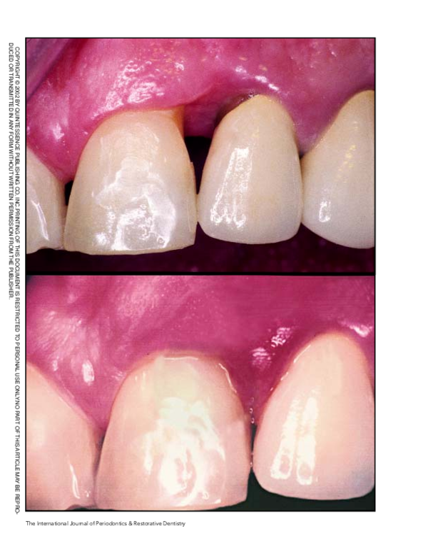 PDF) Interproximal papilla augmentation procedure: a novel