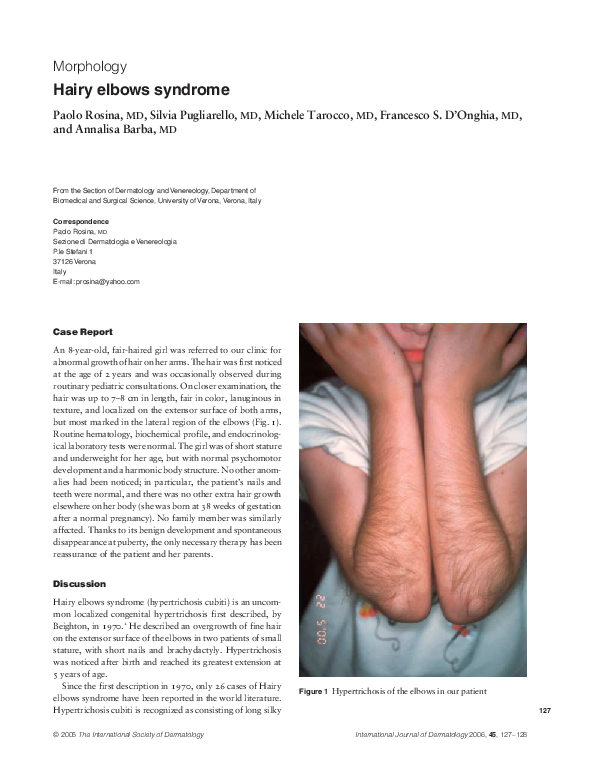 (PDF) Hairy elbows syndrome Michele Tarocco Academia.edu