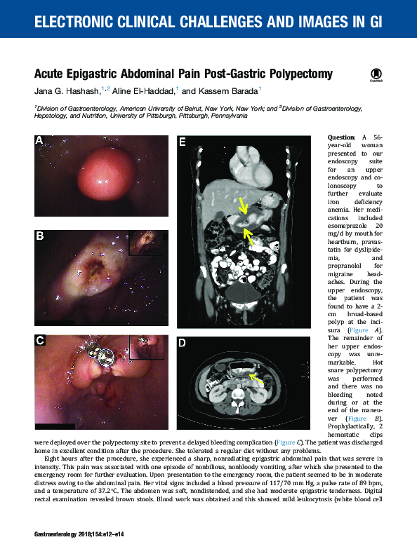 (PDF) Acute Epigastric Abdominal Pain PostGastric Polypectomy Aline