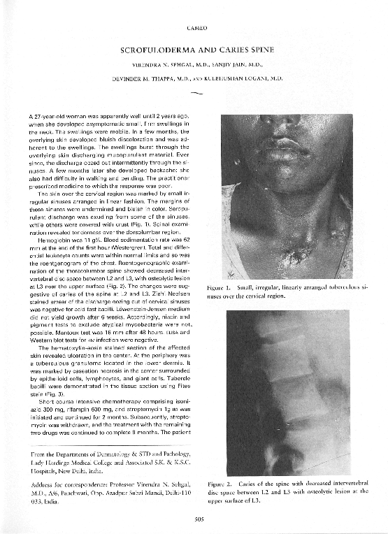 (PDF) Scrofuloderma and Caries Spine