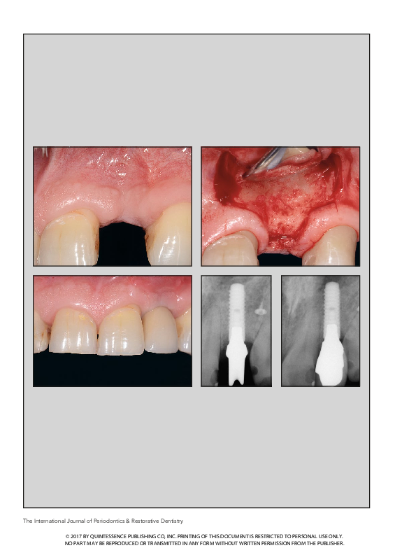 (PDF) Incision Design and Soft Tissue Management to Maintain or ...