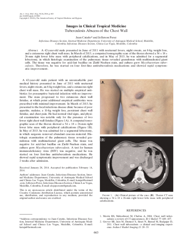 (PDF) Tuberculosis abscess of the chest wall