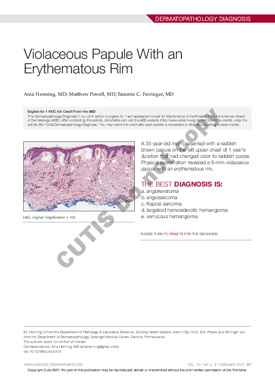 (PDF) Violaceous Papule With an Erythematous Rim