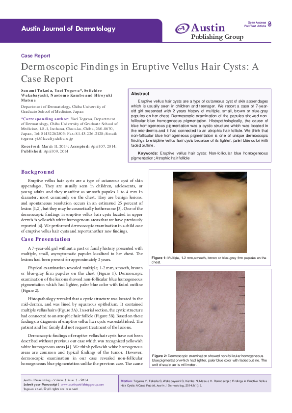 (PDF) Dermoscopic Findings in Eruptive Vellus Hair Cysts A Case Report