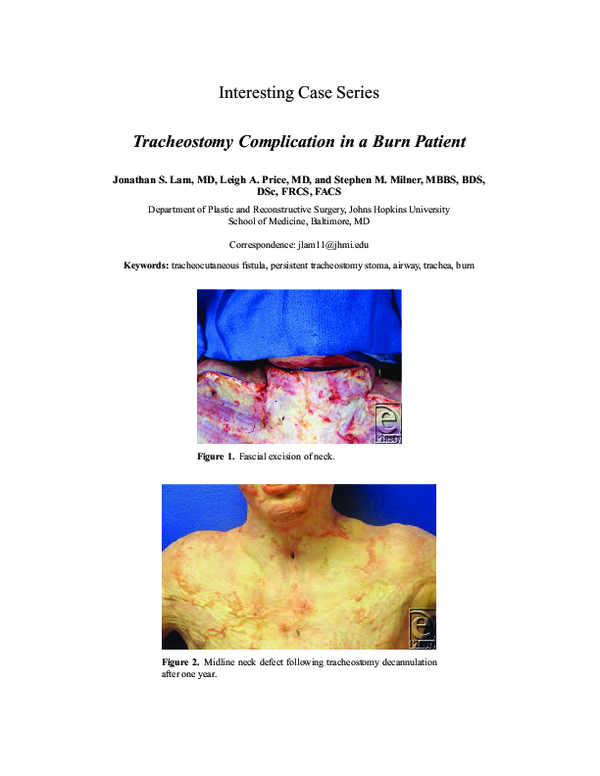 (PDF) Tracheostomy complication in a burn patient Stephen Milner Academia.edu