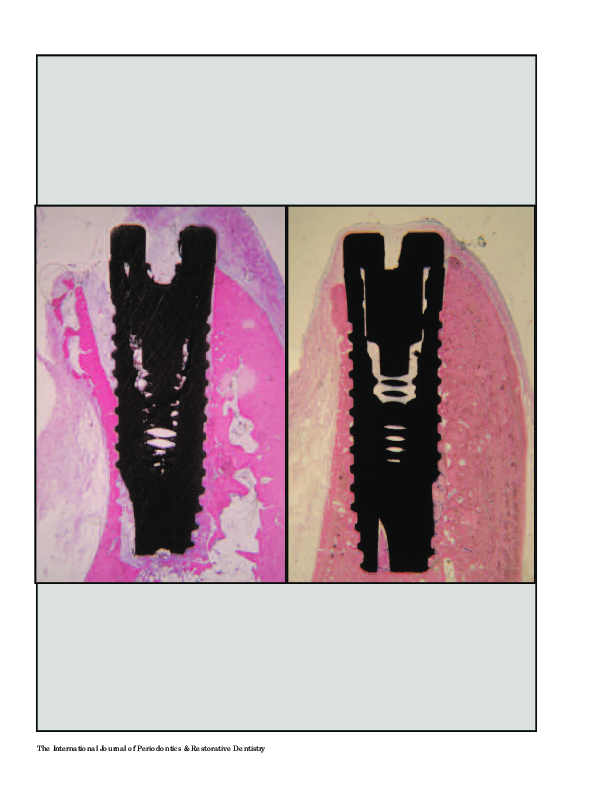 (PDF) Bone remodeling around implants placed in fresh extraction sockets