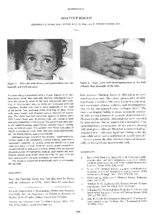 (PDF) Hartnup Disease