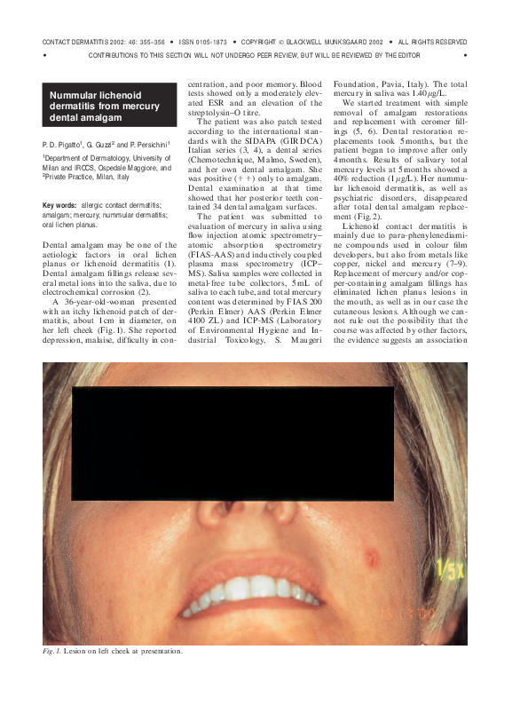 (PDF) Nummular lichenoid dermatitis from mercury dental amalgam P