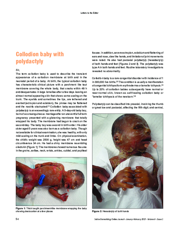 (PDF) Collodion baby with polydactyly