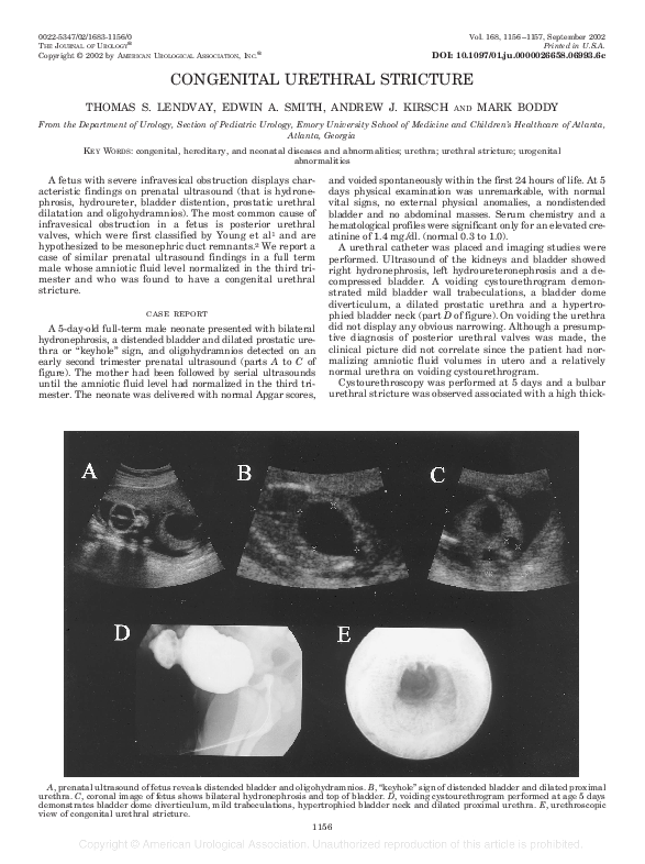 (PDF) Congenital Urethral Stricture
