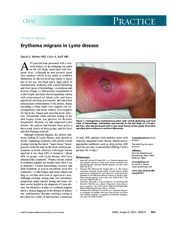 (PDF) Erythema migrans in Lyme disease David Wetter Academia.edu
