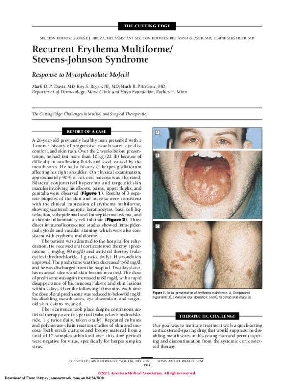 Erythema Multiforme And Stevens Johnson Syndrome