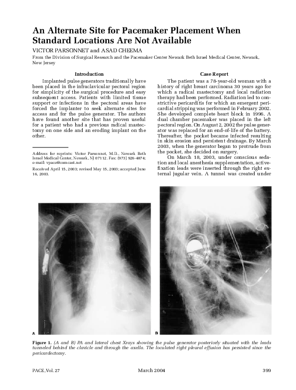 (PDF) An Alternate Site for Pacemaker Placement When Standard Locations ...