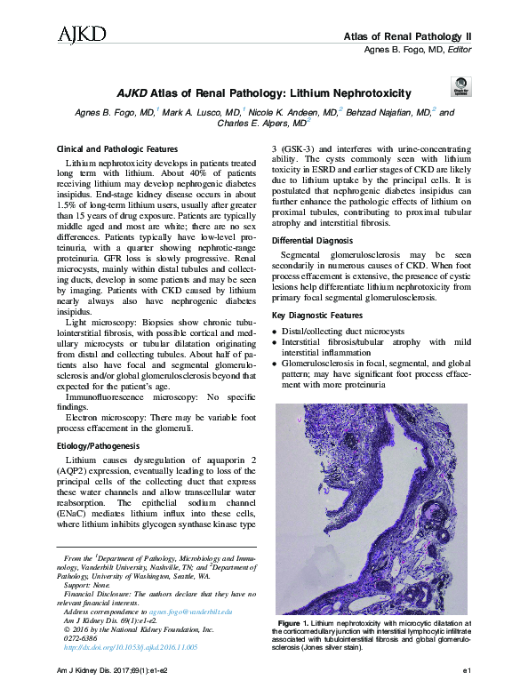 (PDF) AJKD Atlas of Renal Pathology: Lithium Nephrotoxicity
