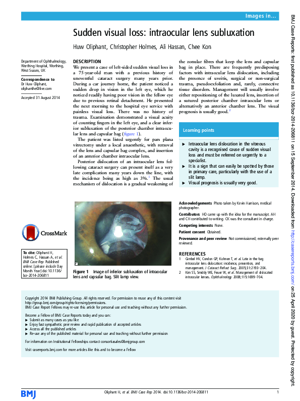 (PDF) Sudden visual loss: intraocular lens subluxation