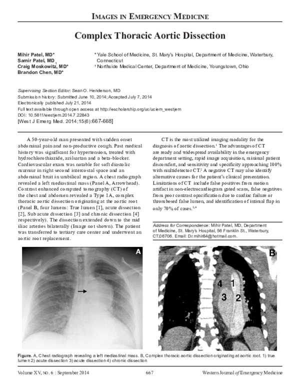 (PDF) Complex Thoracic Aortic Dissection
