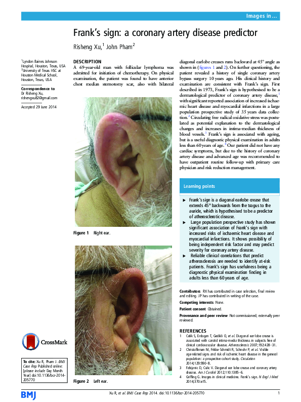 (PDF) Frank's sign: a coronary artery disease predictor