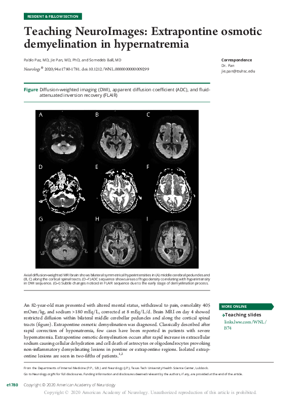(PDF) Teaching NeuroImages: Extrapontine osmotic demyelination in ...