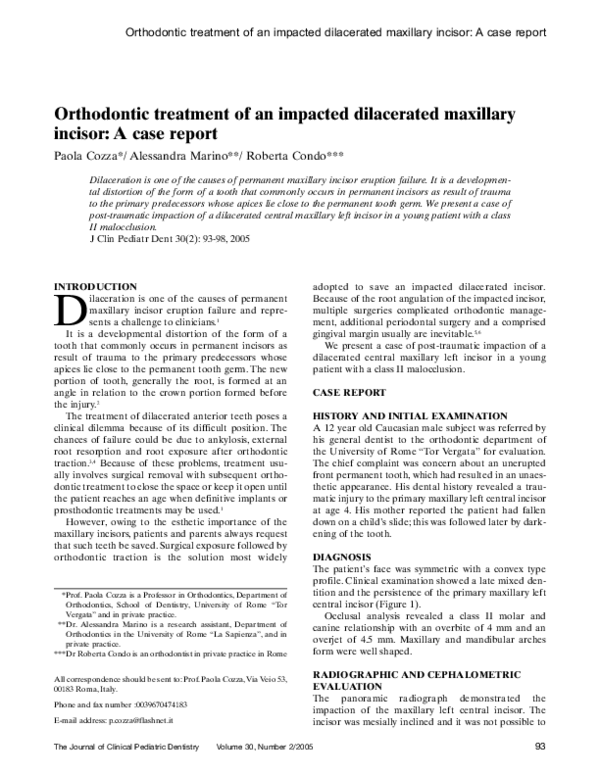 (PDF) Orthodontic treatment of an impacted dilacerated maxillary ...