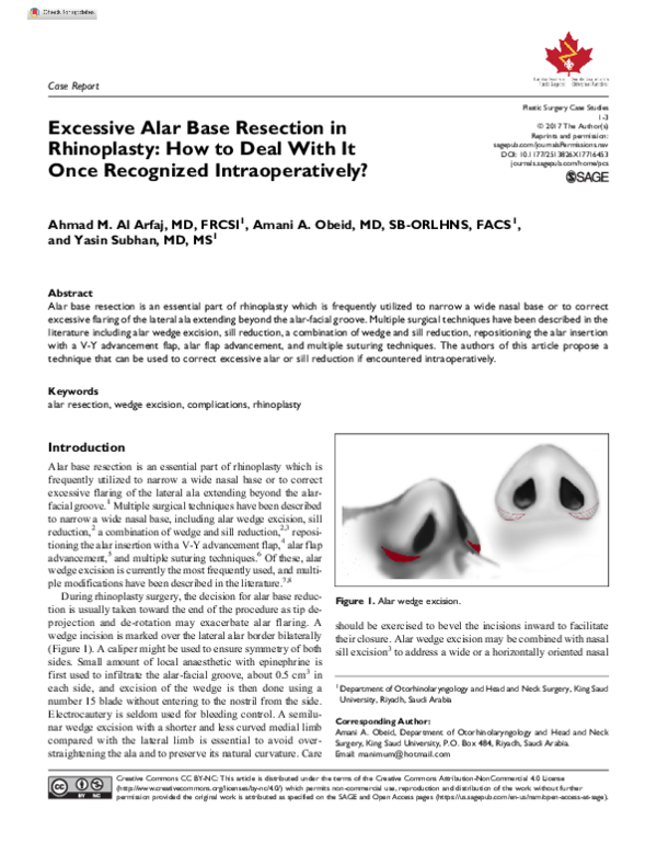 (PDF) Excessive Alar Base Resection in Rhinoplasty