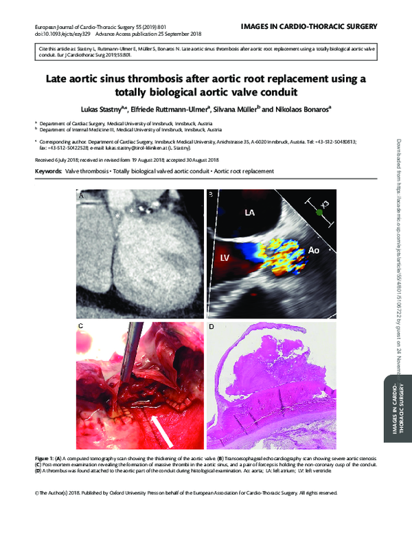 (PDF) Late aortic sinus thrombosis after aortic root replacement using ...