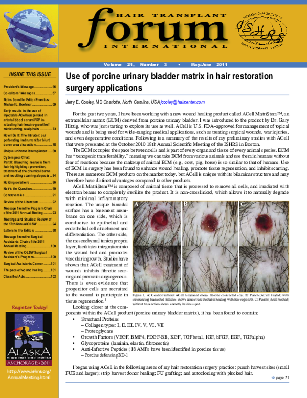 (PDF) Use of porcine urinary bladder matrix in hair restoration surgery