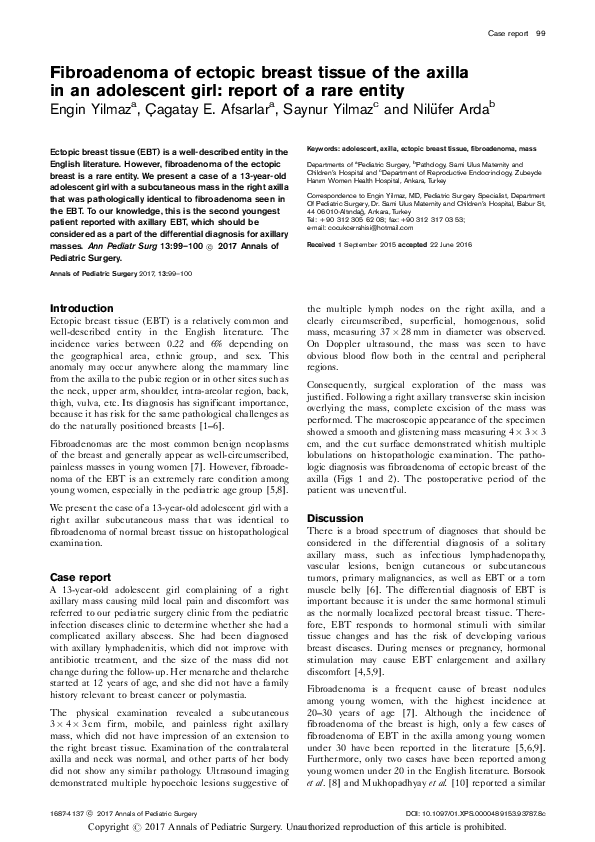 (PDF) Fibroadenoma of ectopic breast tissue of the axilla in an ...