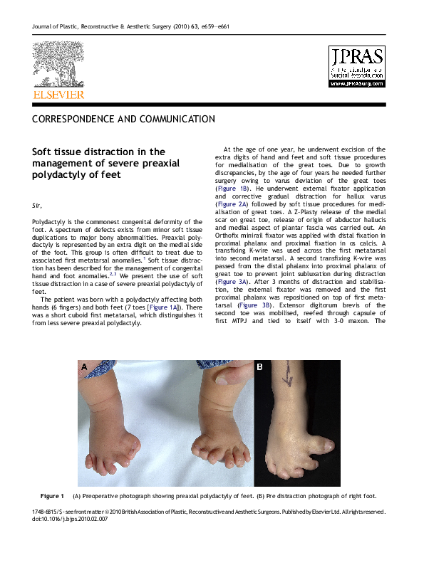 (PDF) Soft tissue distraction in the management of severe preaxial ...