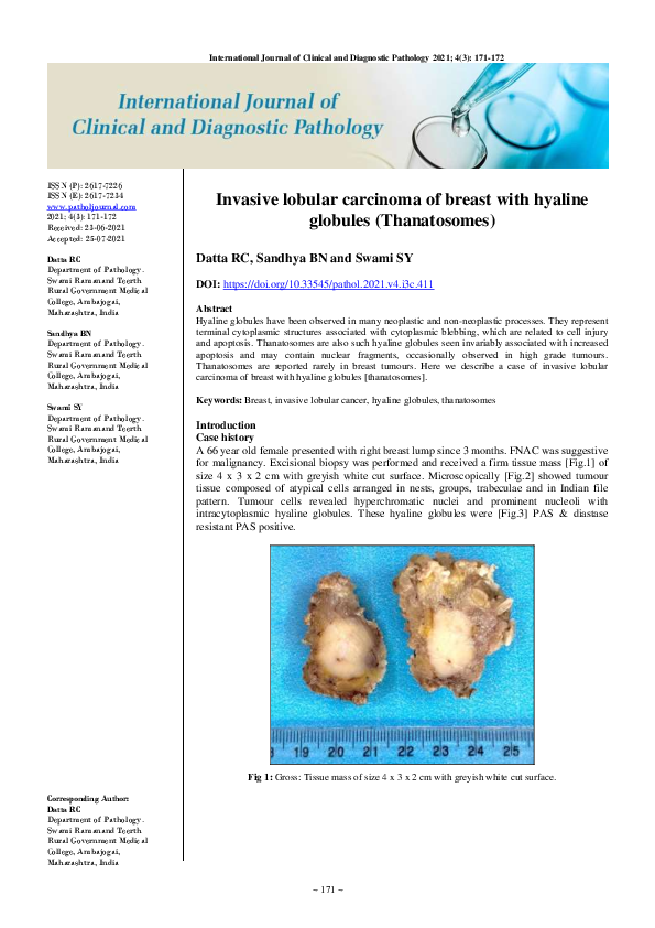 (PDF) Invasive lobular carcinoma of breast with hyaline globules ...