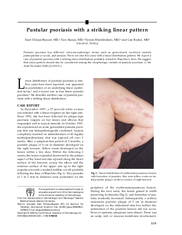 (PDF) Pustular psoriasis with a striking linear pattern