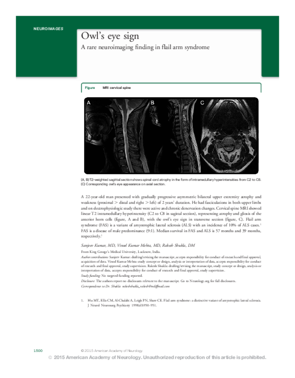 (PDF) Owl's eye sign A rare neuroimaging finding in flail arm syndrome