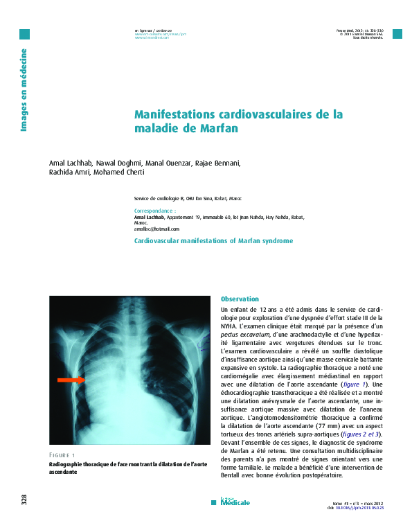 (PDF) Manifestations cardiovasculaires de la maladie de Marfan